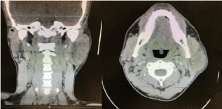 Acute Swelling of the Parotid Gland after Spinal Surgery Under General Anesthesia – A Case Report