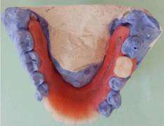 Management of Severe Periodontitis in Hemodialysis Patient: A Case Report