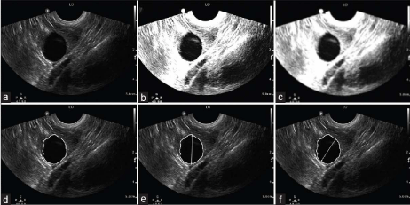 Comparison of Follicular Assessment Using a Manual Versus Automated 2D Ultrasound Method