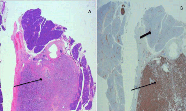 Pancreatic Neuroendocrine Tumor with Intraductal Growth